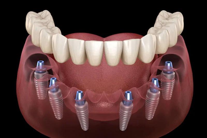 Full mouth dental implants, all on four graphic