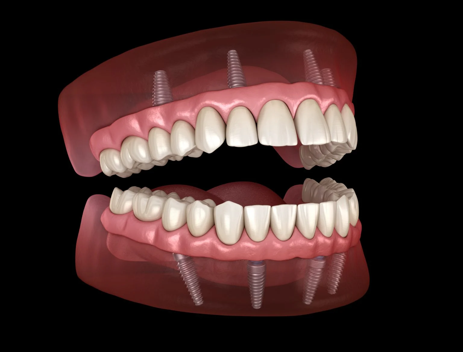 All-On-4 Dental Implants: Your Complete Guide To Full Arch Restoration