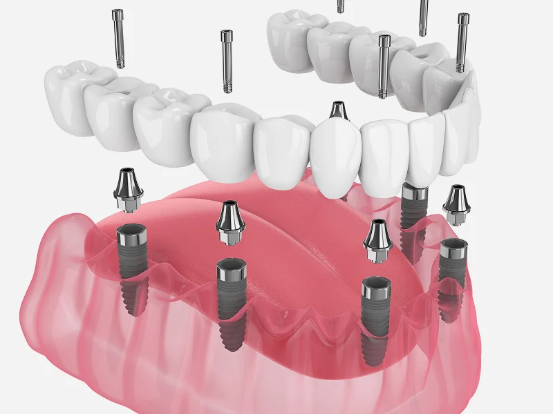 Full Arch Dental Implants