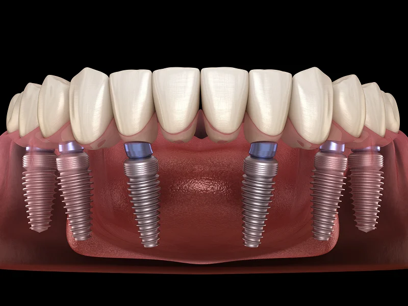 Full Mouth Dental Implants