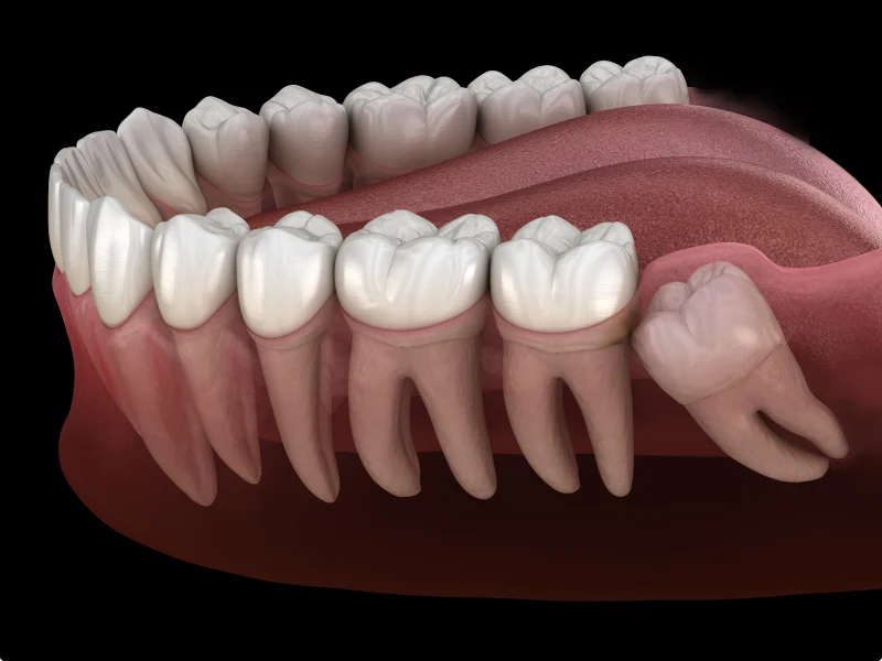 Impacted Tooth