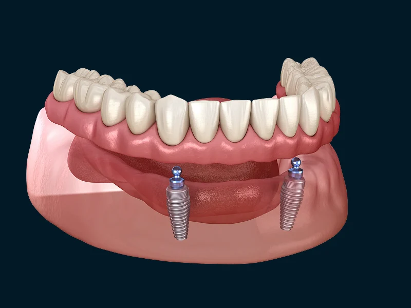 Implant Supported Dentures