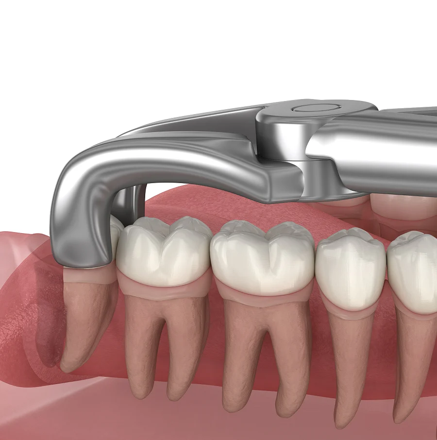 What Is Wisdom Teeth Removal