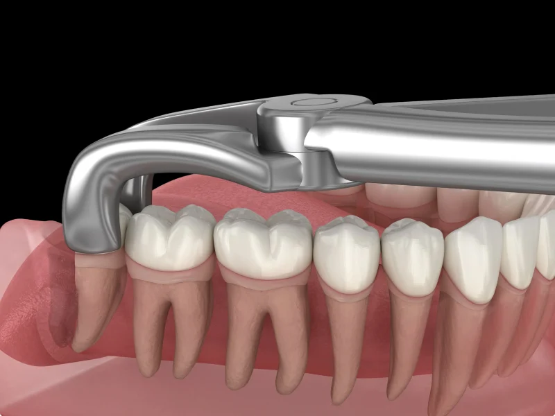 Wisdom Teeth Removal