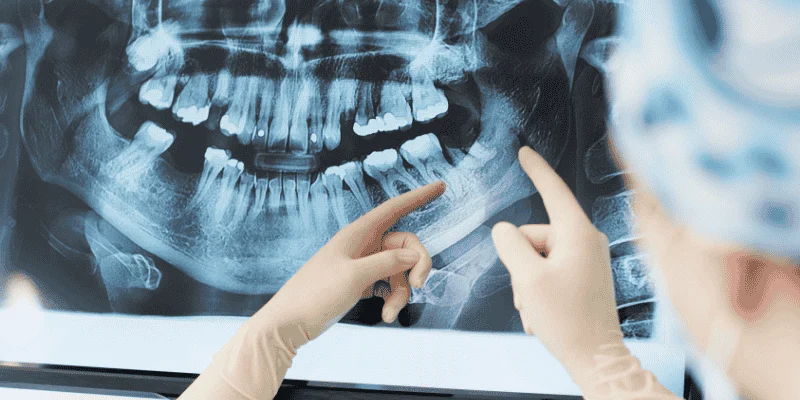 Bone Loss After Tooth Extraction: How Fast It Happens &Amp; Why Implants Matter