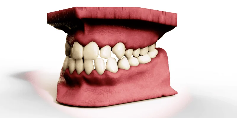 Dental Implants And Sinus Health: Essential Upper Jaw Patient Guide