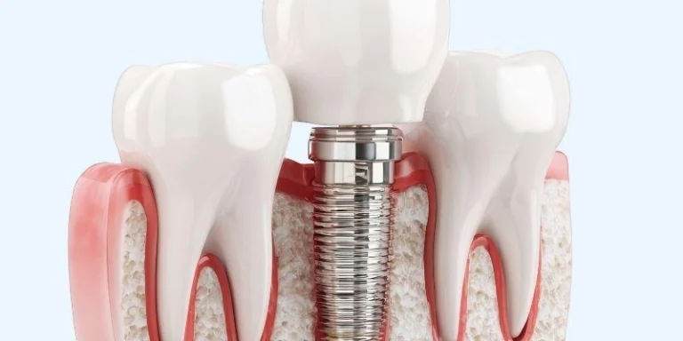 Early Signs You May Need Dental Implants Before Tooth Loss Worsens: Key Indicators & Solutions